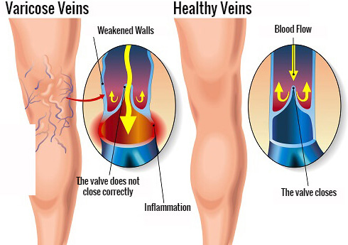 Carrot Juice Heals Spider Veins